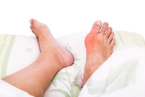 gout on foot